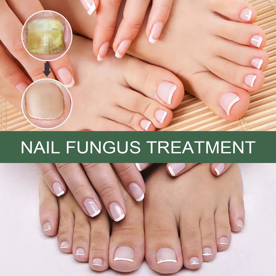 Fast Nail Fungal Treatments Nail Repair Essences Serum