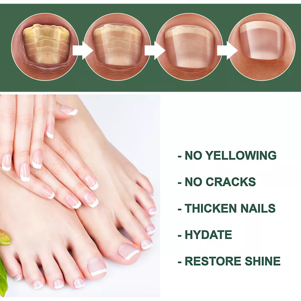 Fast Nail Fungal Treatments Nail Repair Essences Serum